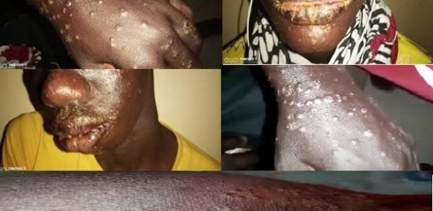 Senegal grapples with mysterious disease