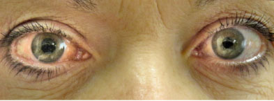 ‘7.7 Million people have moderate or severe blindness from glaucoma’