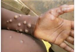 Mpox