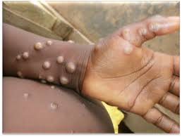 Gambia declares mpox outbreak