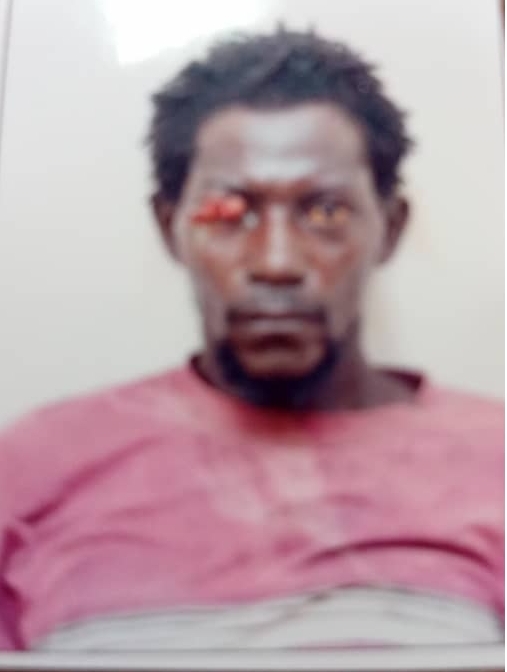 Man suffering from rare Fumigating Mass on Eyelid seeks assistance  