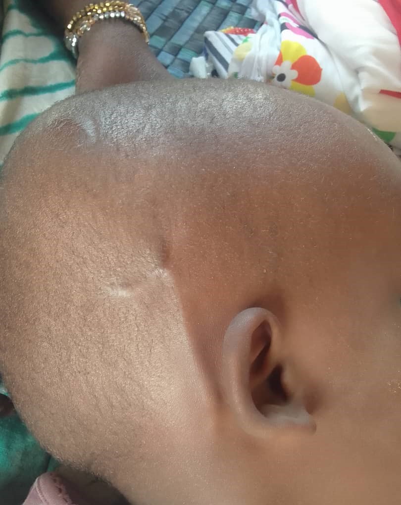 Mother’s plea: Help save Sainabou Bah from hydrocephalus