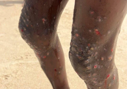 Scabies