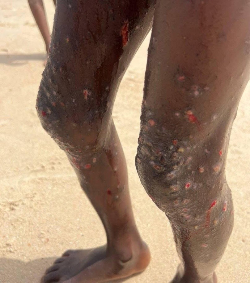 Joint operation uncovers scabies outbreak at Daara Medina Suwaneh