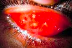 Gambia certified on elimination of trachoma