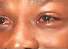 Public urged to seek early treatment for conjunctivitis Apollo