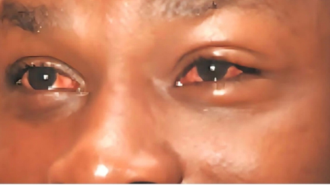 Public urged to seek early treatment for conjunctivitis Apollo