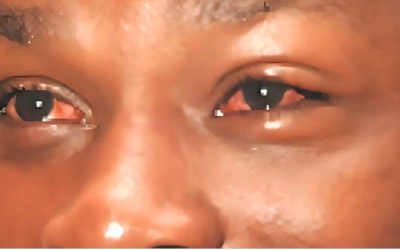 Public urged to seek early treatment for conjunctivitis Apollo