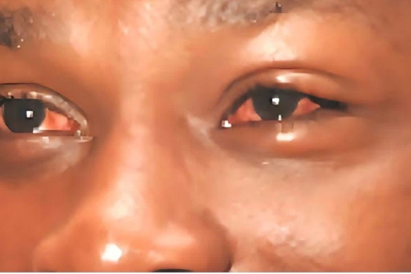 Public urged to seek early treatment for conjunctivitis Apollo