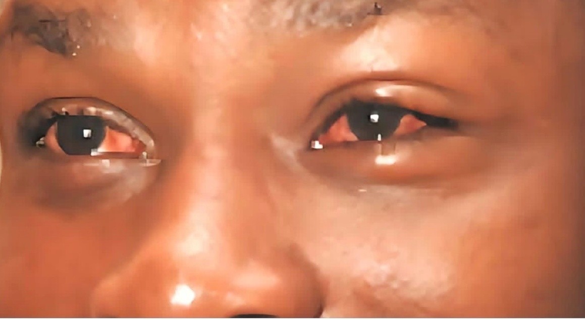 Public urged to seek early treatment for conjunctivitis Apollo