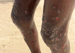 scabies v2