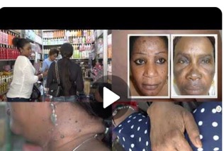 Senegal battles 100% morbidity due to skin bleaching