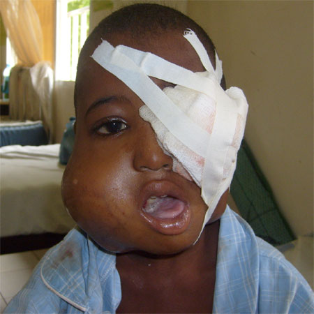 Seven Year-Old Samba Bah Needs Urgent Overseas Treatment