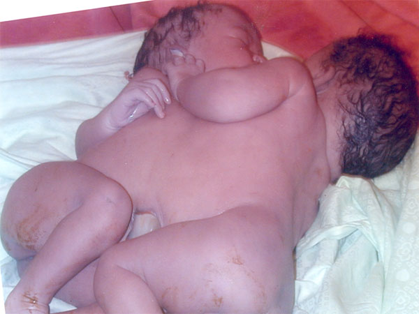 Mother Gives Birth to Live Conjoined Twins at GFPA Clinic