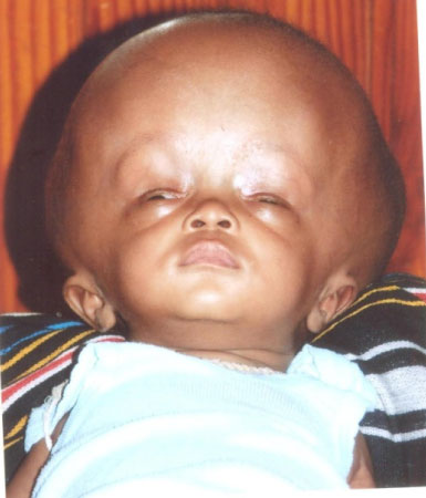 Ninety-day-old baby needs urgent overseas treatment for head enlargement