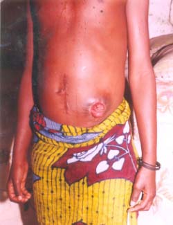 Girl 8, needs urgent overseas treatment, as she could not relieve herself
