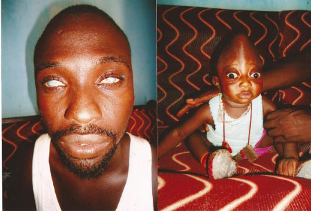 Father and son seek support to undergo overseas eye treatment