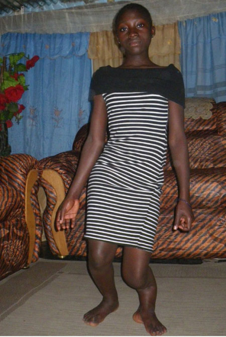 Girl, 13, needs help as she finds it difficult to walk