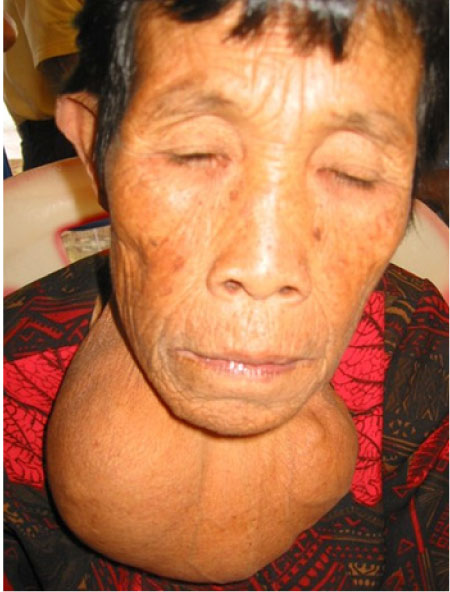 Presentation by Dr John Egbuta on Iodine deficiency, others