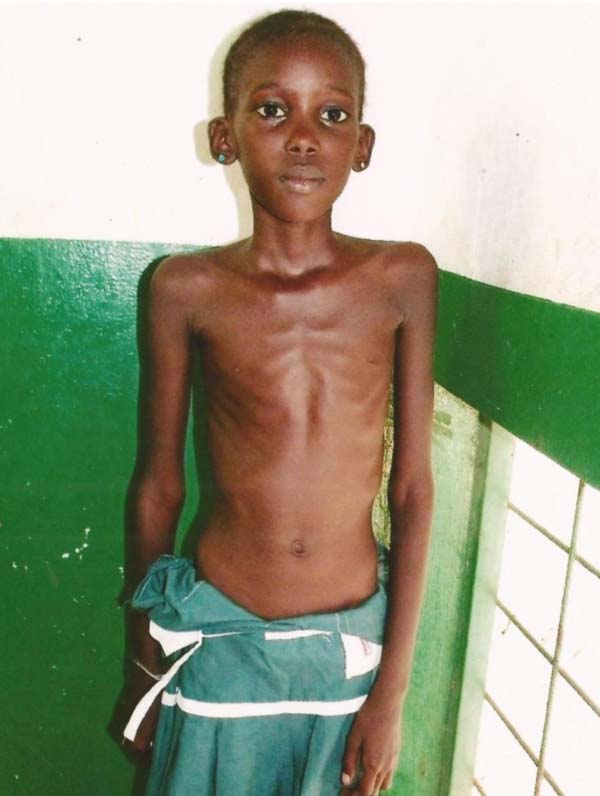 12-year-old girl in need of urgent support to undergo overseas treatment