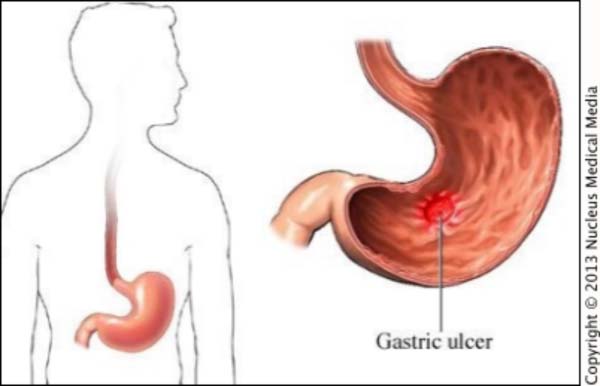STOMACH ULCER DISEASE IN THE GAMBIA