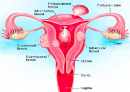 uterine fibroide