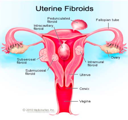 SHE SHE SHE: Women and Uterine Fibroid