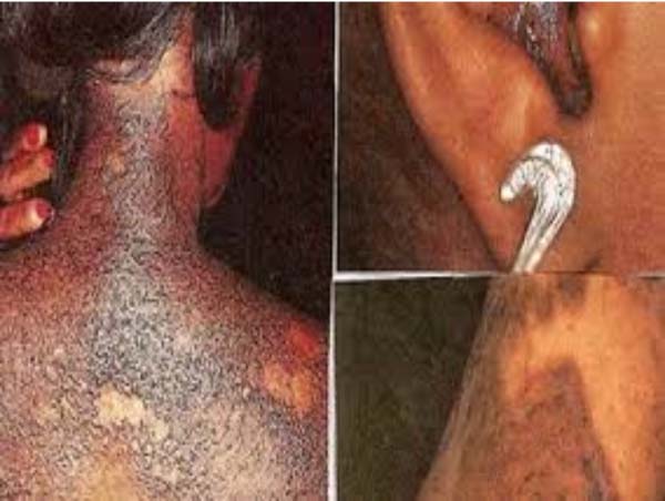 Bleaching: not a solution to flawless skin